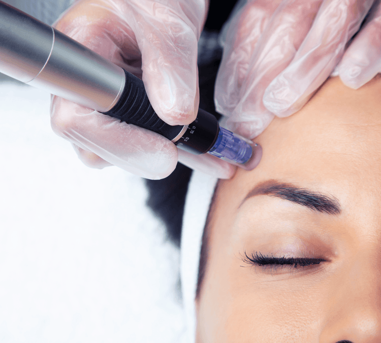 Microneedling